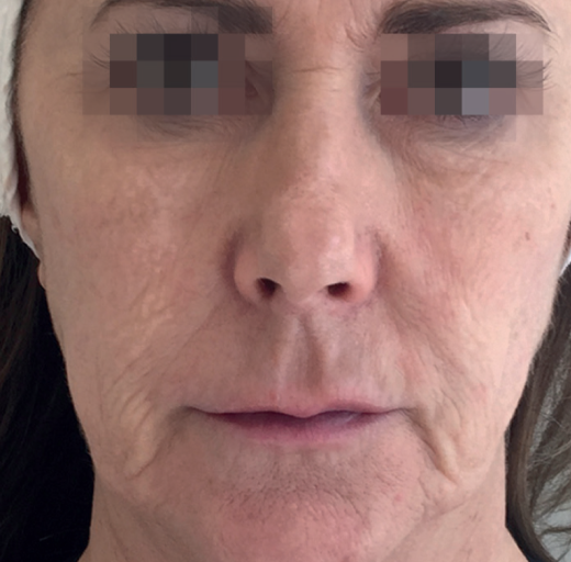 Before/After Image